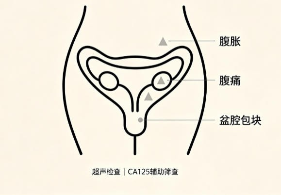 卵巢癌