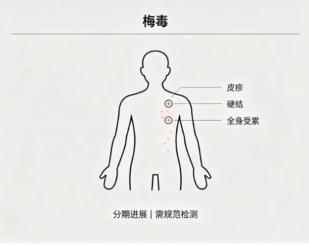 梅毒