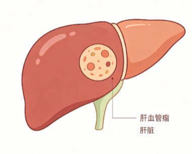 肝血管瘤
