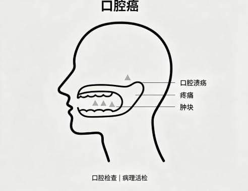 口腔癌