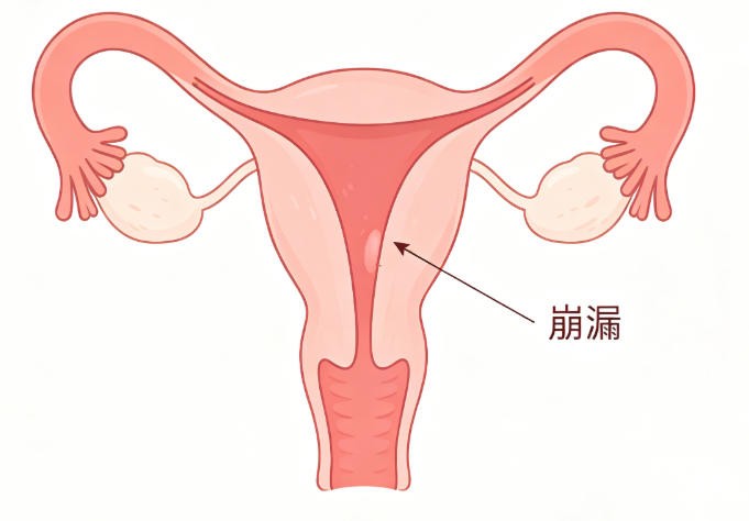 月经崩漏