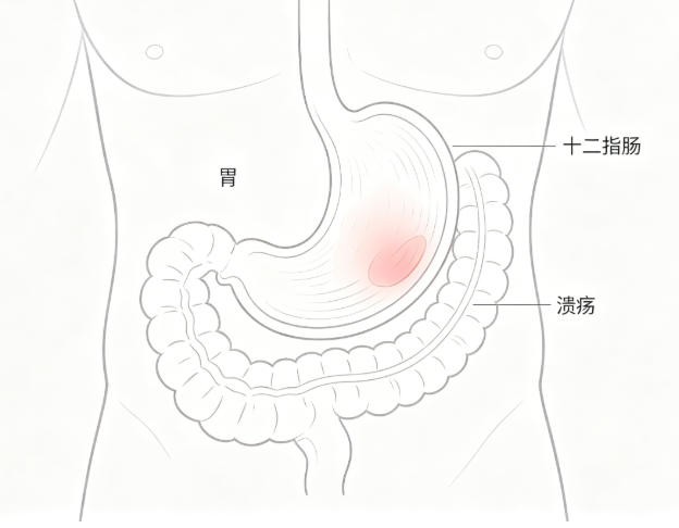 胃及十二指肠溃疡