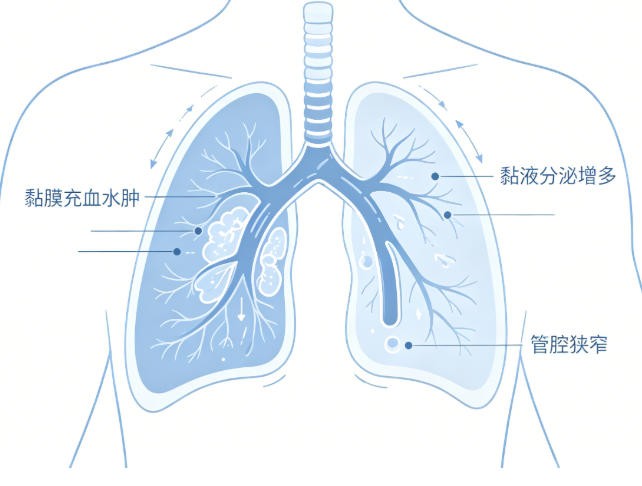 慢性支气管炎