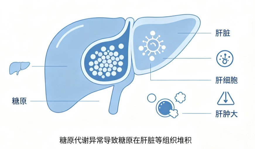 糖原累积症