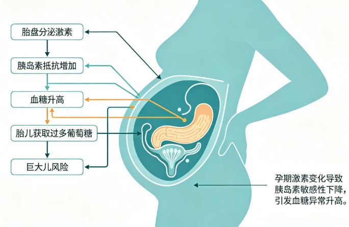 妊娠期糖尿病