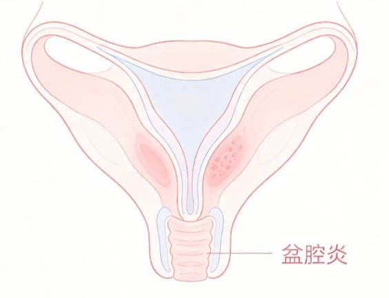 盆腔炎