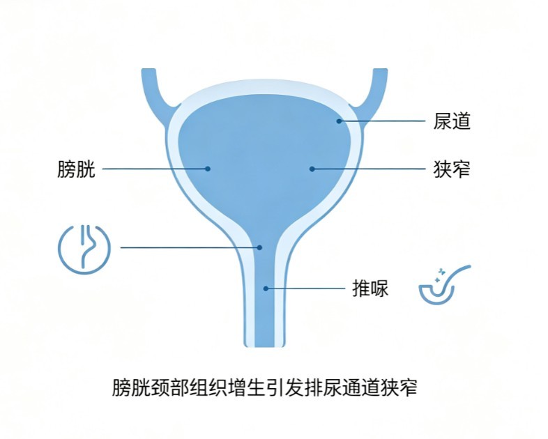 膀胱颈挛缩