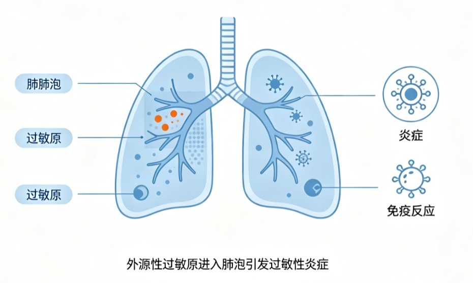 外源性过敏性肺泡炎