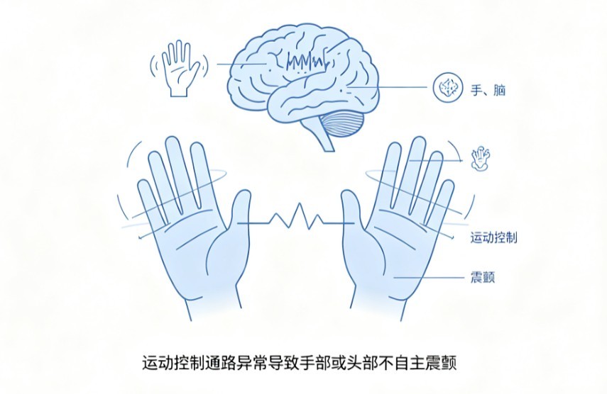 特发性震颤