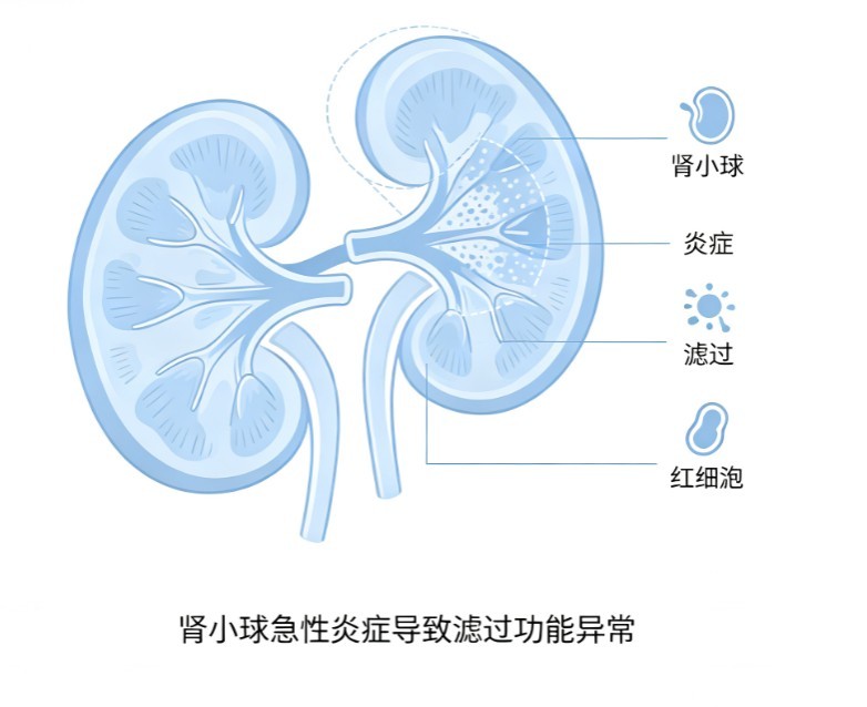 急性肾小球肾炎