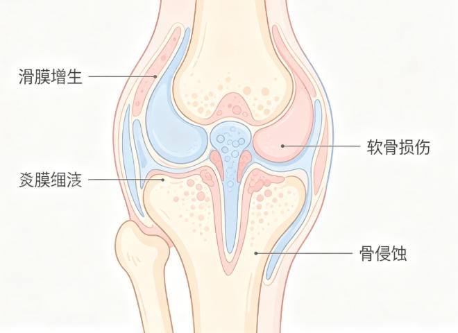 类风湿关节炎