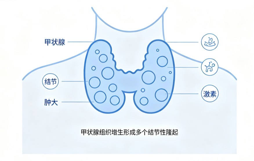 结节性甲状腺肿