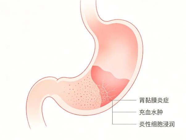 慢性胃炎