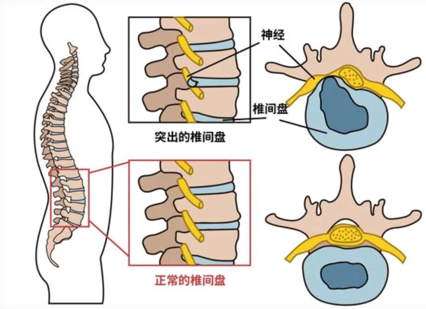 得了腰间盘突出必须睡硬床吗？这两个误区很多人还在犯