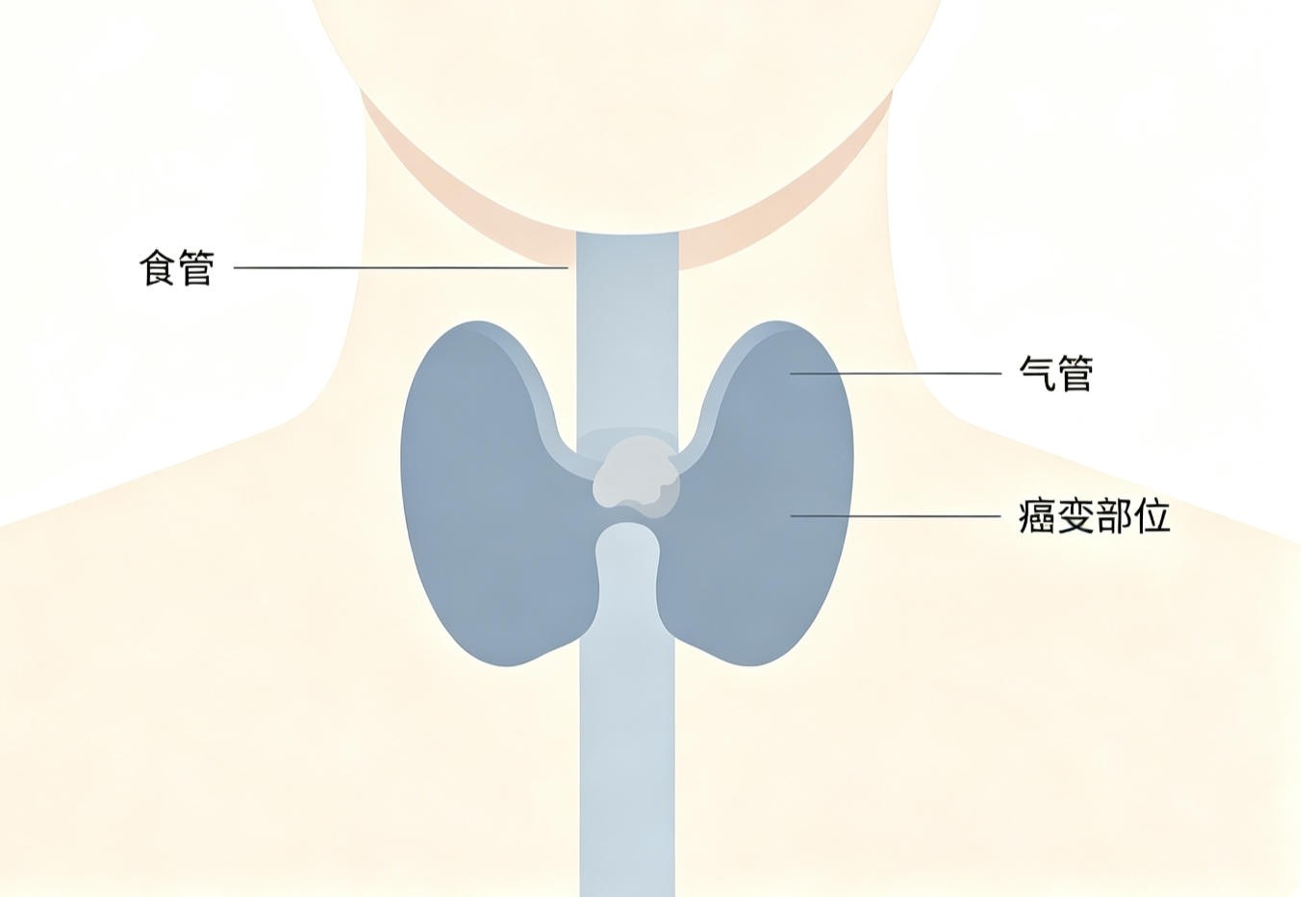 食管癌