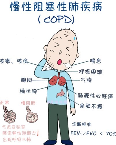 慢阻肺患者下肢血栓的表现有哪些？如何预防？